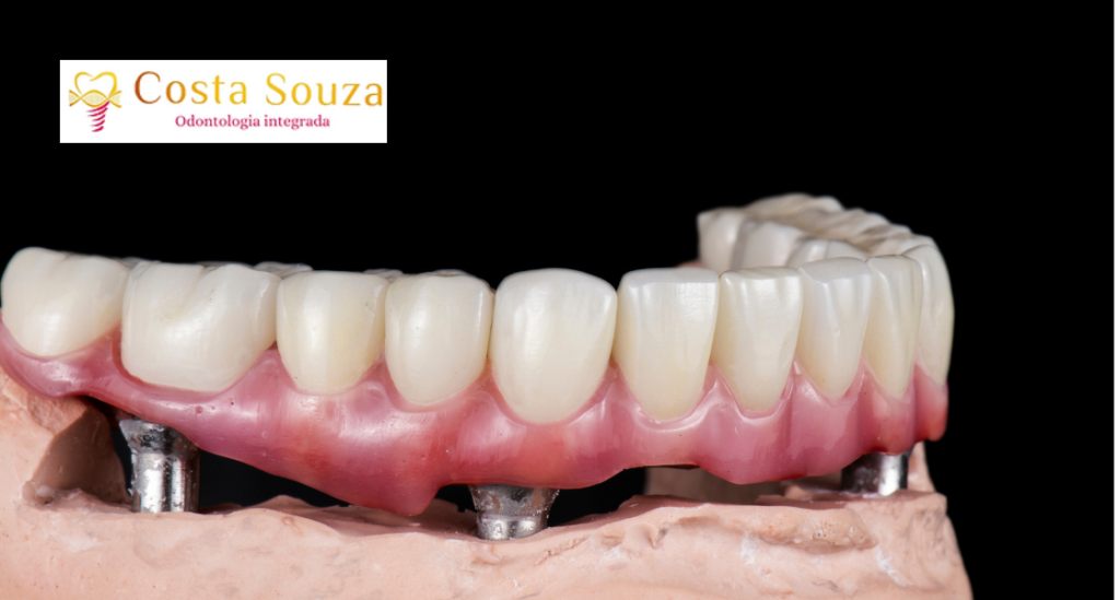 O que é Implantodontia